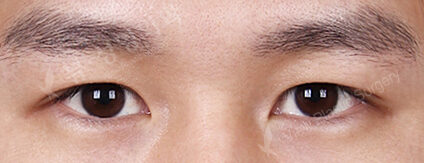 Combination Ptosis Correction Surgery (3 Months) — After