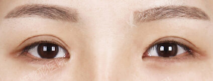 Revisional Eye Surgery+Epicanthoplasty+Lower Canthoplasty (6 Months) — Before