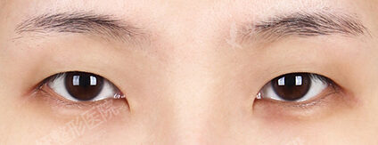 Combination Ptosis Correction Surgery+Epicanthoplasty+Lateral Canthoplasty+Lower Canthoplasty (3 Months) — Before
