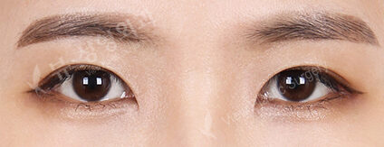 Combination Ptosis Correction Surgery+Epicanthoplasty+Lateral Canthoplasty+Lower Canthoplasty (3 Months) — After