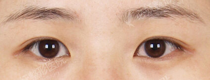 Combination Ptosis Correction Surgery+Epicanthoplasty (6 Months) — Before