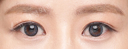 Combination Ptosis Correction Surgery+Epicanthoplasty (6 Months) — After
