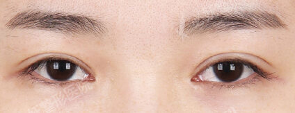 Revisional Eye Surgery+Lower Canthoplasty+Lateral Canthoplasty (3 Months) — Before