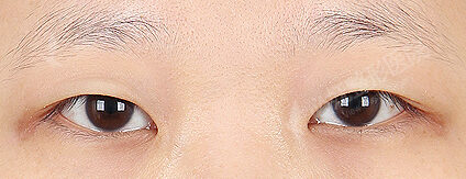 Ptosis Correction+Epicanthoplasty(3 Months) — Before