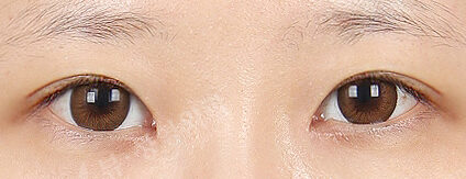 Ptosis Correction+Epicanthoplasty(3 Months) — After