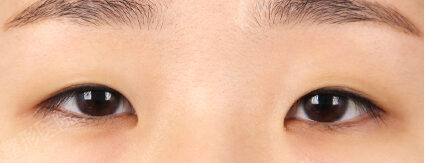 Combination Ptosis Correction Surgery+Epicanthoplasty+Lateral Canthoplasty+Lower Canthoplasty (11 Months) — Before