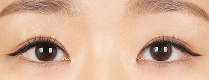 Combination Ptosis Correction Surgery+Epicanthoplasty+Lateral Canthoplasty+Lower Canthoplasty (11 Months) — After
