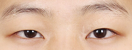 Ptosis Correction(8 Months) — Before