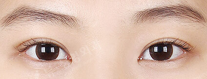 Ptosis Correction(8 Months) — After
