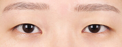 Combination Ptosis Correction Surgery+Epicanthoplasty (6 Months) — Before