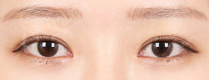 Combination Ptosis Correction Surgery+Epicanthoplasty (6 Months) — After
