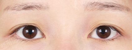 Incisional Ptosis Correction+Epicanthoplasty (4 Months) — Before