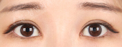 Incisional Ptosis Correction+Epicanthoplasty (4 Months) — After