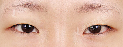 Ptosis Correction+Epicanthoplasty+Lower Canthoplasty+Transconjuntival fat removal(4 Months) — Before