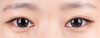 Ptosis Correction+Epicanthoplasty+Lower Canthoplasty+Transconjuntival fat removal(4 Months) — After