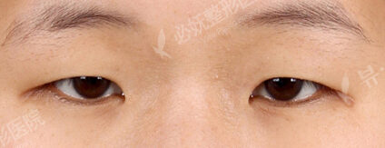 Ptosis Correction+Sub-Brow Lift+Magic Epicanthoplasty+Lateral Canthoplasty+Lower Canthoplasty (3 Months ) — Before
