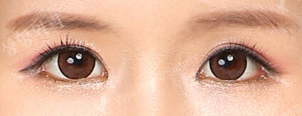 Ptosis Correction+Sub-Brow Lift+Magic Epicanthoplasty+Lateral Canthoplasty+Lower Canthoplasty (3 Months ) — After