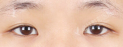 Eye Surgery+Burial+Epicanthoplasty+Lateral Canthoplasty(4 Months) — Before