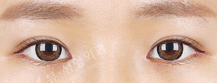 Eye Surgery+Burial+Epicanthoplasty+Lateral Canthoplasty(4 Months) — After
