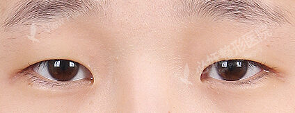 Ptosis Correction+Epicanthoplasty(6 Months) — Before