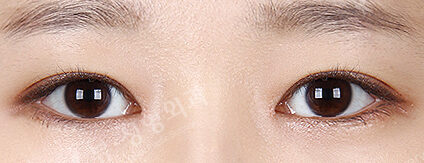 Ptosis Correction+Epicanthoplasty(6 Months) — After
