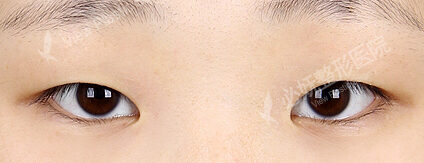 Ptosis Correction+Epicanthoplasty(12 Months) — Before