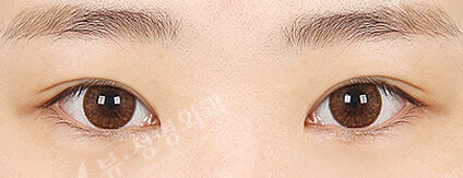 Ptosis Correction+Epicanthoplasty(12 Months) — After