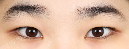 Combination Ptosis Correction Surgery+Epicanthoplasty+Lateral Canthoplasty+Lower Canthoplasty (5 Months) — Before