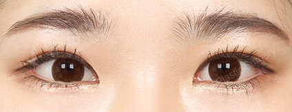 Combination Ptosis Correction Surgery+Epicanthoplasty+Lateral Canthoplasty+Lower Canthoplasty (5 Months) — After