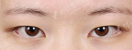Ptosis Correction+Epicanthoplasty(9 Months) — Before