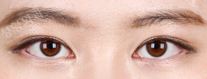 Ptosis Correction+Epicanthoplasty(9 Months) — After