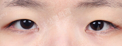 Double Eyelid (Incisional)+ Epicanthoplasty (3 Months) — Before