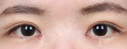 Double Eyelid (Incisional)+ Epicanthoplasty (3 Months) — After