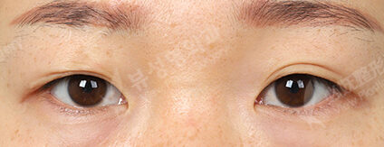 Transconjuntival fat removal+Epicanthoplasty+Lateral Canthoplasty (6 Months) — Before
