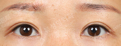 Transconjuntival fat removal+Epicanthoplasty+Lateral Canthoplasty (6 Months) — After