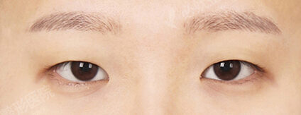 Ptosis+Epicanthoplasty (4 Months) — Before