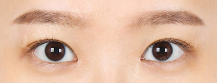 Ptosis+Epicanthoplasty (4 Months) — After