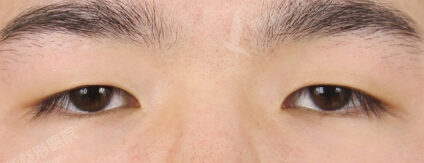 Combination Ptosis Correction Surgery (3 Months) — Before