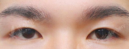 Combination Ptosis Correction Surgery (3 Months) — After