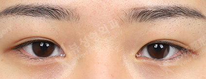 Incisional Ptosis Correction+Lateral Canthoplasty+Lower Canthoplasty (3 Months) — Before