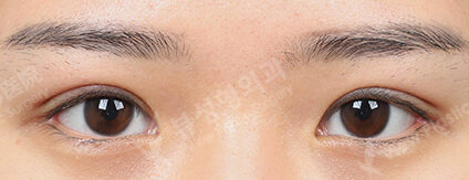 Incisional Ptosis Correction+Lateral Canthoplasty+Lower Canthoplasty (3 Months) — After