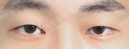 Fat Graft+Ptosis (9 Months) — Before