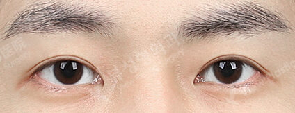 Fat Graft+Ptosis (9 Months) — After