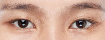 Incisional Ptosis Correction+Lateral Canthoplasty+Lower Canthoplasty (6 Months) — Before
