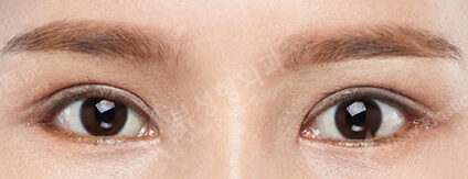 Incisional Ptosis Correction+Lateral Canthoplasty+Lower Canthoplasty (6 Months) — After