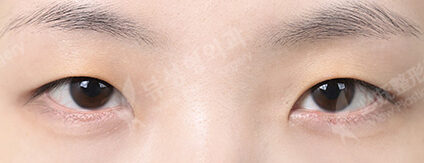 Fat Graft+Ptosis+Epicanthoplasty (5 Months) — Before