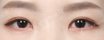 Fat Graft+Ptosis+Epicanthoplasty (5 Months) — After