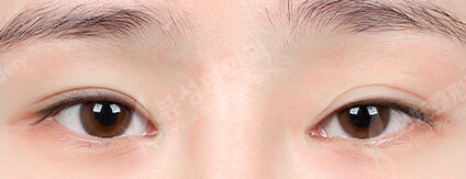 Ptosis (Incisional)+ Lower Canthoplasty (6 Months) — Before