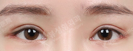 Ptosis (Incisional)+ Lower Canthoplasty (6 Months) — After