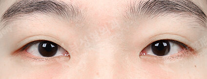 Double Eyelid (Incisional)+ Epicanthoplasty (3 Months) — Before
